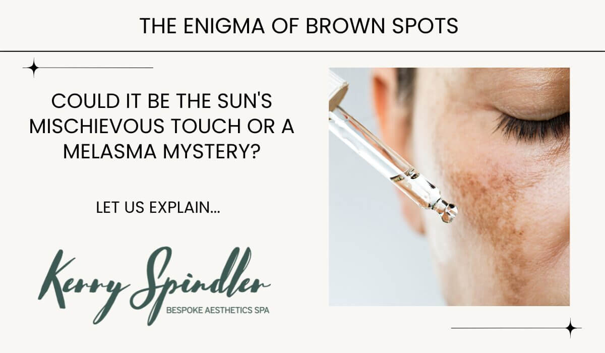melasma