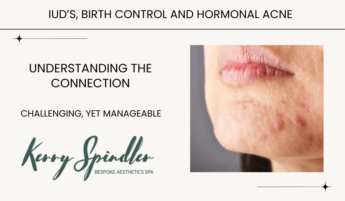 hormonal acne